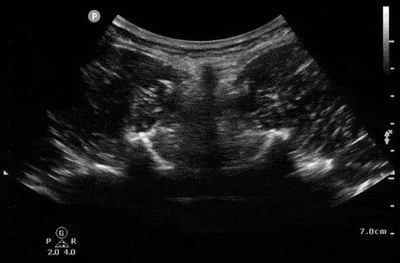 Pre-puncture lumbar spine ultrasound